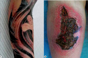 – Emergency Medicine EducationTattoo-related Complications in the Emergency Department - Emergency Medicine Education – Emergency Medicine EducationTattoo-related Complications in the Emergency Department - Emergency Medicine Education