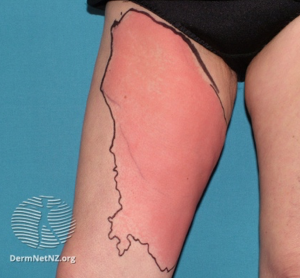 – Emergency Medicine EducationTattoo-related Complications in the Emergency Department - Emergency Medicine Education – Emergency Medicine EducationTattoo-related Complications in the Emergency Department - Emergency Medicine Education