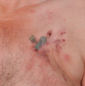 – Emergency Medicine EducationTattoo-related Complications in the Emergency Department - Emergency Medicine Education – Emergency Medicine EducationTattoo-related Complications in the Emergency Department - Emergency Medicine Education