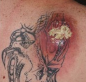 – Emergency Medicine EducationTattoo-related Complications in the Emergency Department - Emergency Medicine Education – Emergency Medicine EducationTattoo-related Complications in the Emergency Department - Emergency Medicine Education
