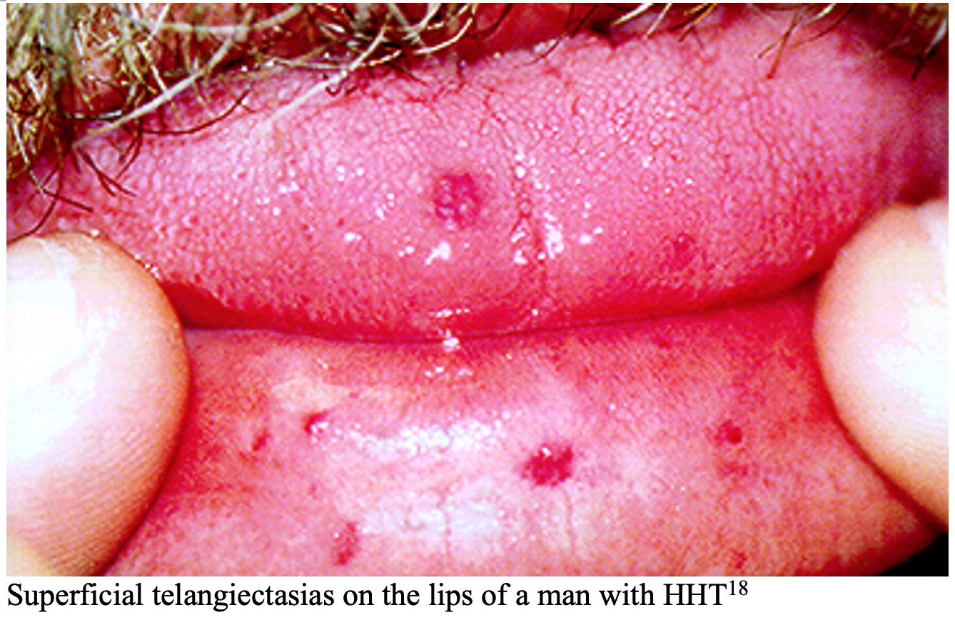EM@3AM: Bleeding Disorders