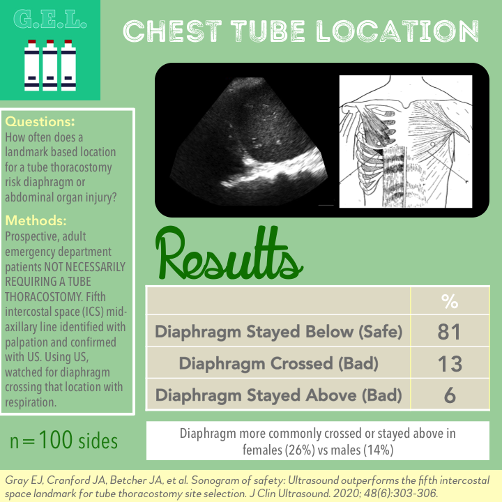 Ultrasound G.E.L. – Chest Tube Location: Using POCUS to Assess Diaphragm Position