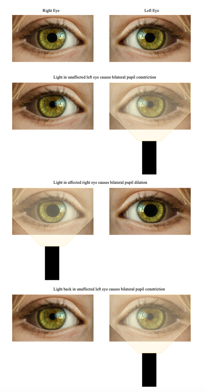 Optic Neuritis: ED Evaluation and Management