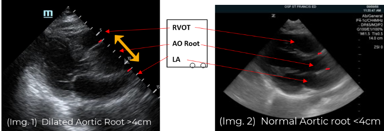POCUS for aortic dissection in the clinical presentation of ischemic stroke