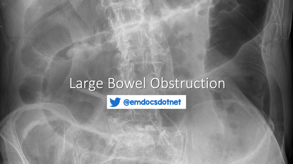 EmDOCs Emergency Medicine EducationLarge Bowel Obstruction ED EmDOCs Emergency Medicine EducationLarge Bowel Obstruction ED