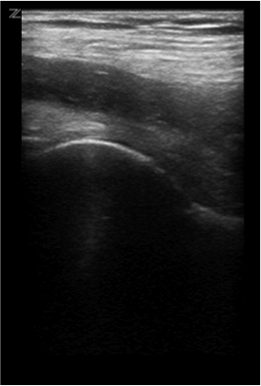 Normal sonographic hip