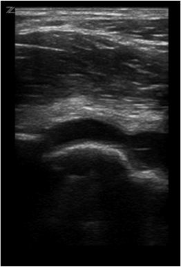 Positive joint effusion