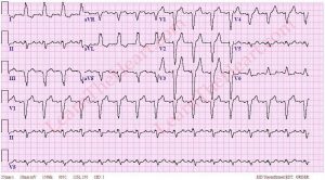 LBBB22