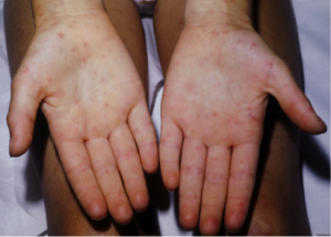 RMSF Rash1