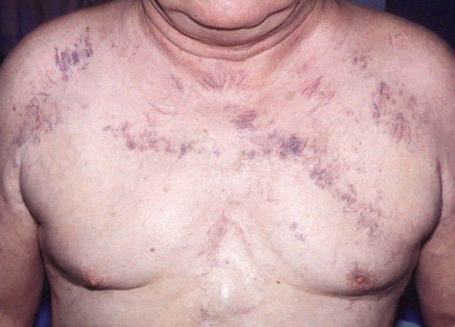 chest