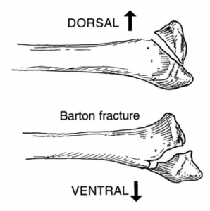 Barton