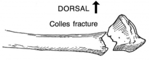Colles