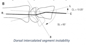 Dorsal intercalated seg instability