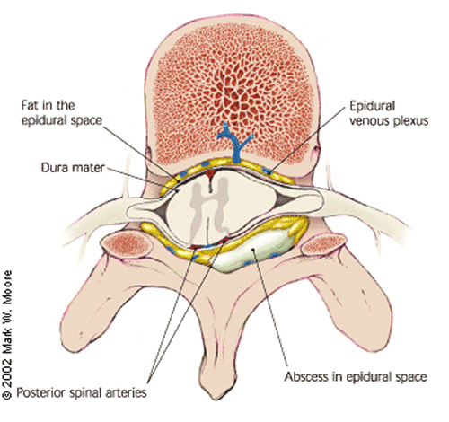 spinalepidural1