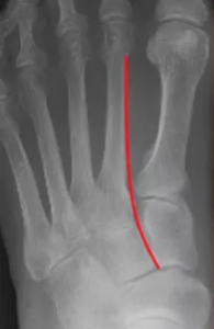 Lisfranc