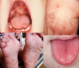 HFM findings
