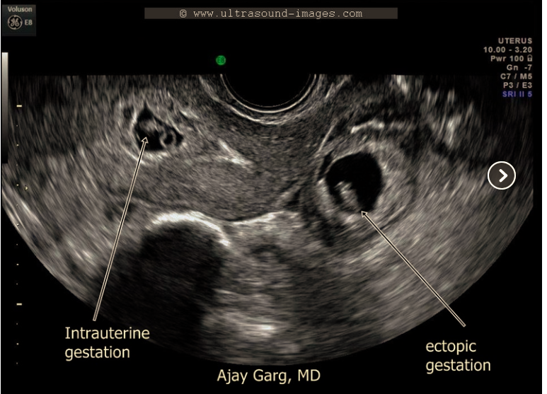 heterotopic