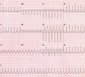 ekg1