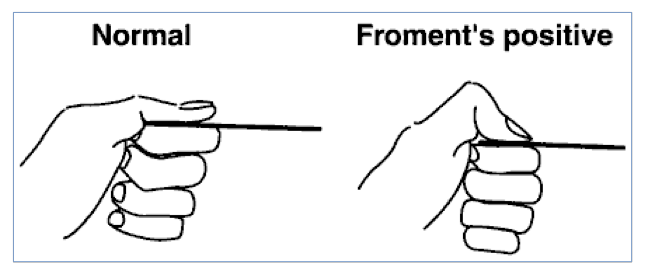Figure 3. Froment's Test Ujash S. Physical Exam of the Hand. 2017. Available from: http://www.orthobullets.com/hand/6008/physical-exam-of-the-hand#