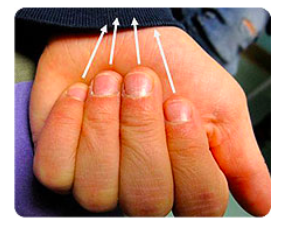 Figure 2. Assessment of Malrotation Steinman S. Seattle Children’s Hospital Finger Fractures: Don’t Forget the Malrotation. 2017. Available from: http://www.seattlechildrens.org/healthcare-professionals/resources/case-studies/finger-fractures-dont-forget-rotation/ 