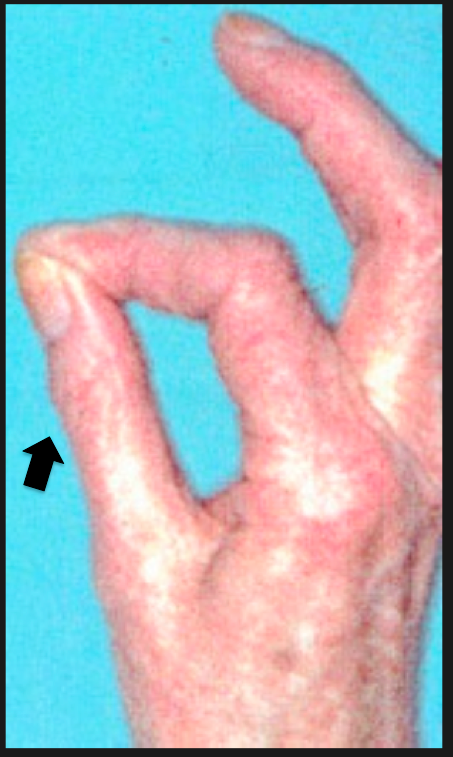 Figure 4. Positive Jeanne's Test Ujesh, S. Physical Exam of the Hand. 2017. Available from: http://www.orthobullets.com/hand/6008/physical-exam-of-the-hand