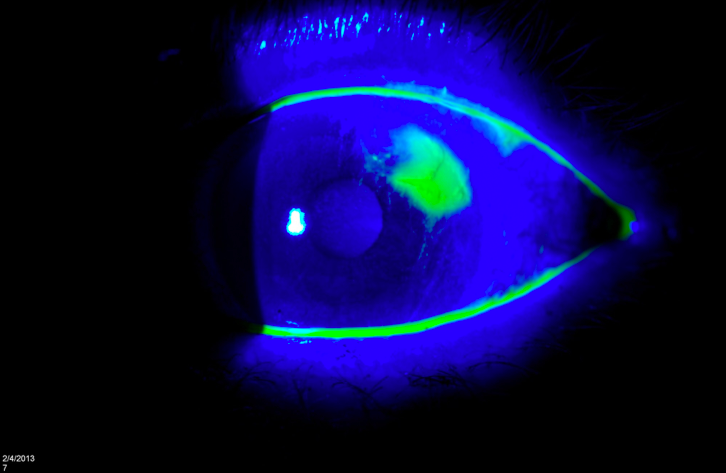 EmDOCs Revamp Corneal Abrasion EmDocs EmDOCs Revamp Corneal Abrasion EmDocs