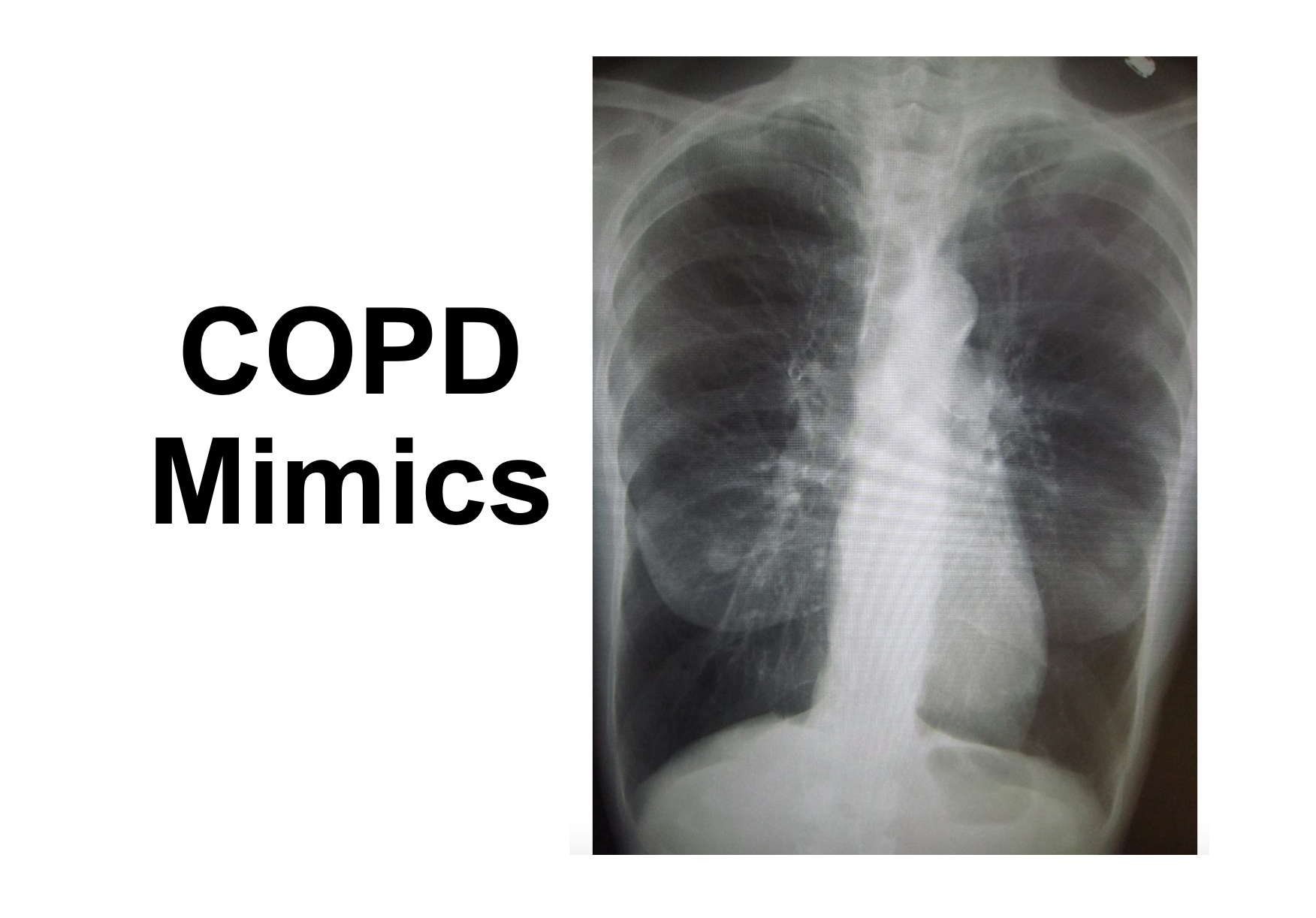 Chest X Ray For Copd