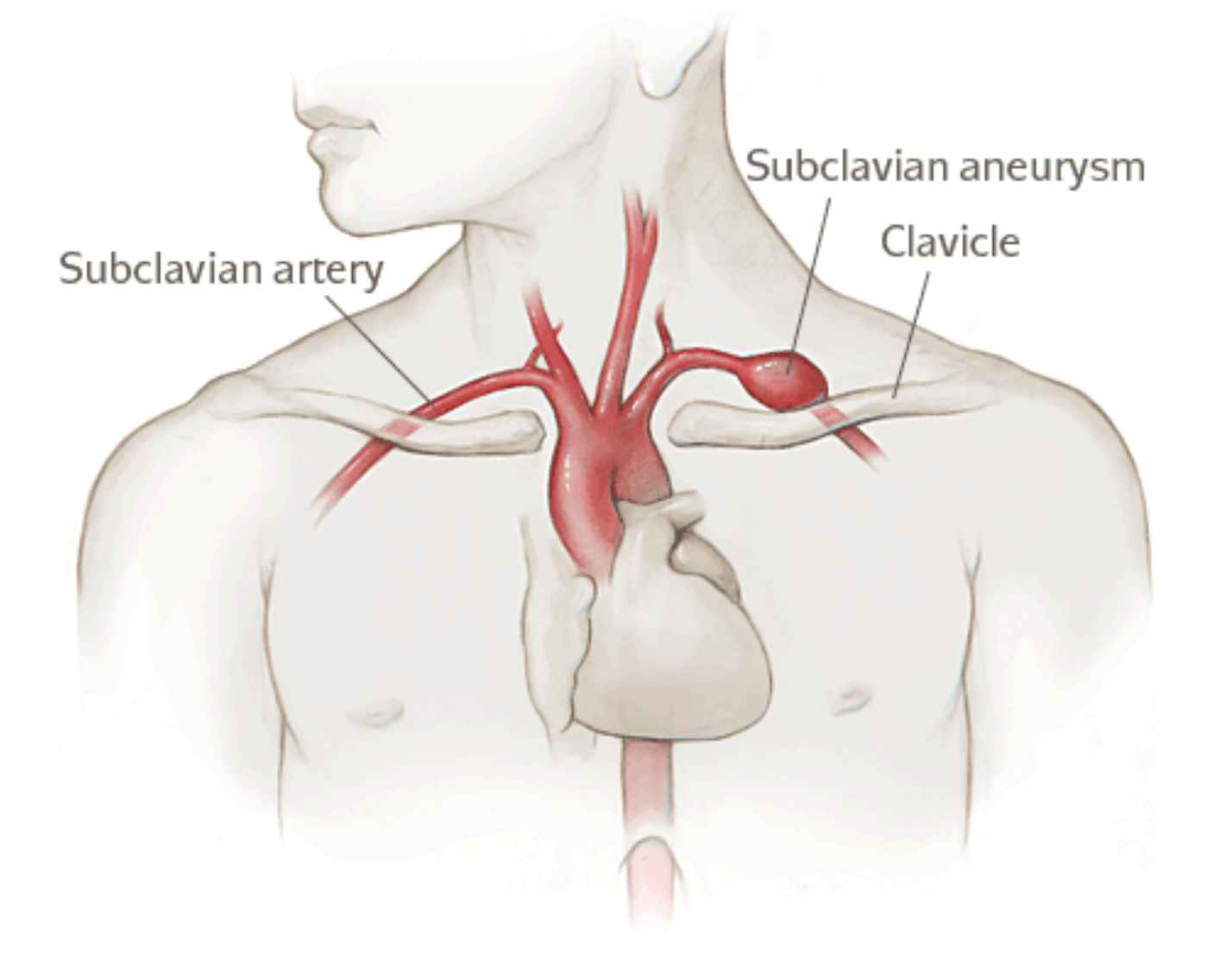 Стеноз подключичной. Аневризма подключичной артерии симптомы. Аневризма правой подключичной артерии. Сонная артерия и аорта. Аневризма подключичной артерии справа.