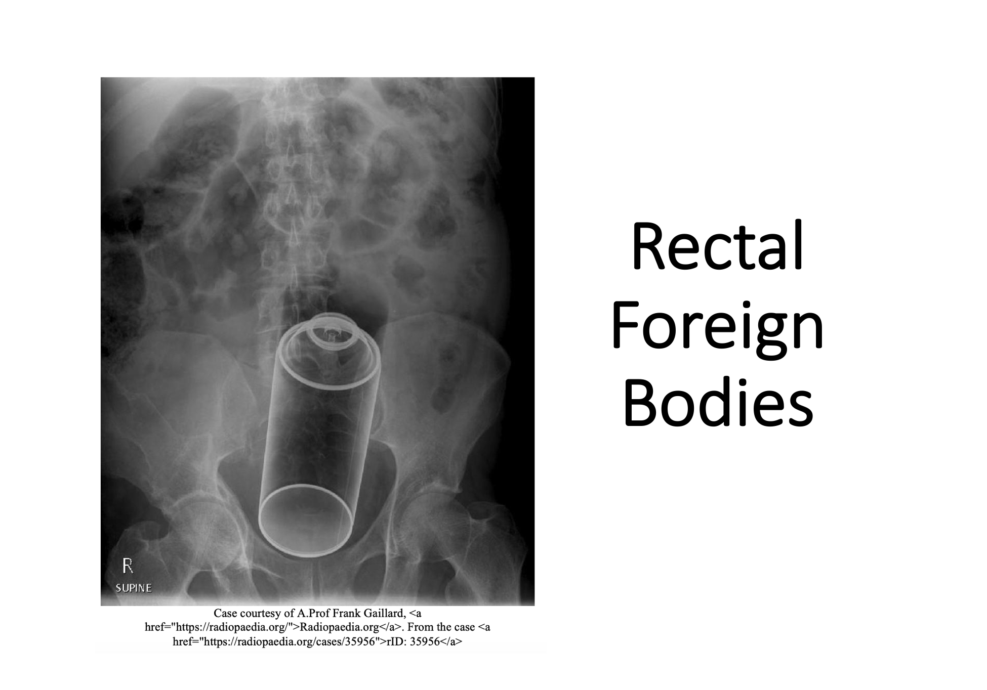 – Emergency Medicine Educationrectal Foreign Bodies Archives
