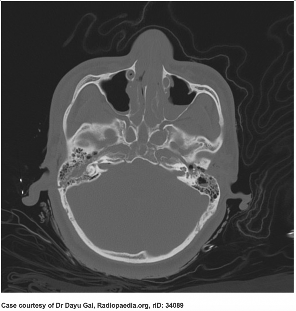 Emergency Medicine EducationEM3AM Basilar Skull