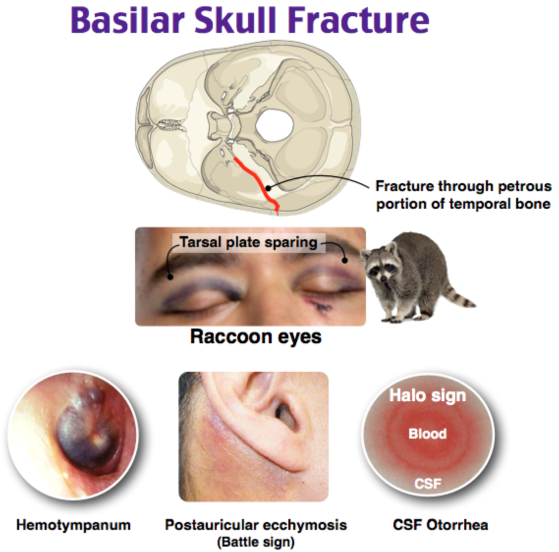 Base Of The Skull Fracture