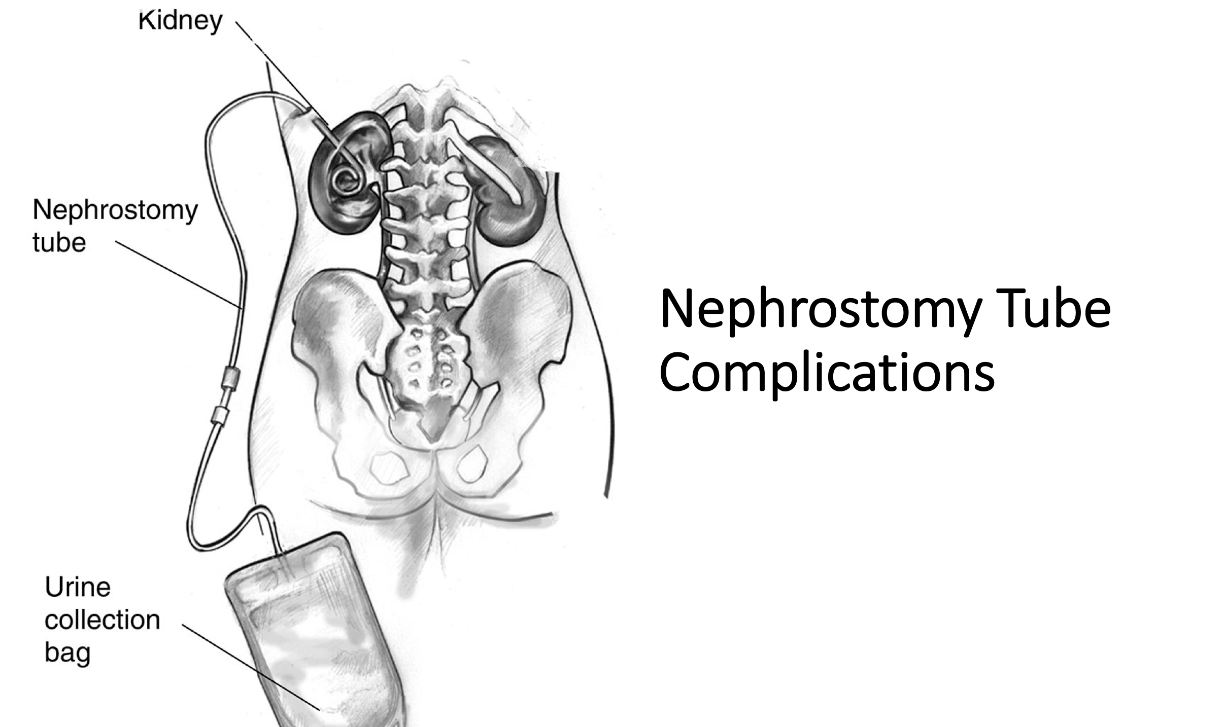 How to Collect a Urine Culture from a Nephrostomy Tube: A Comprehensive Guide