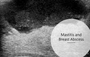 mastitis