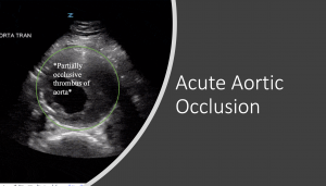 Acute aortic occlusion header