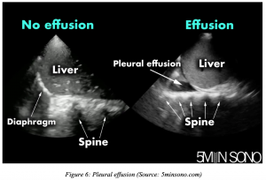 POCUS pleural effusion