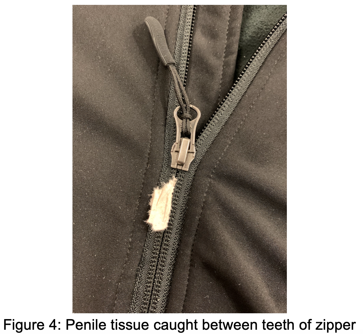 Unlocking Common ED Procedures: Penile Zipper Injuries and Entrapment ...