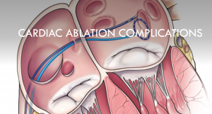 Cardiac ablation complications header