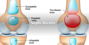 Septic bursitis header