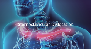 Sternoclavicular dislocation header
