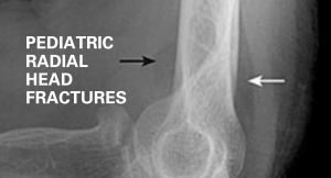 Pediatric radial head fractures header