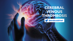 Cerebral venous thrombosis header
