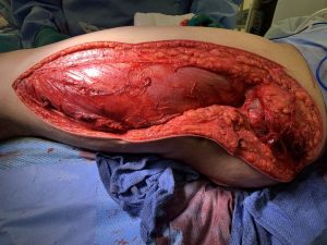Compartment syndrome operating room image