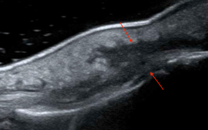 Linear transducer in longitudinal plane demonstrating peritendinous effusion (red arrows) concerning for tenosynovitis on POCUS