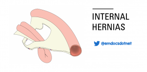Internal hernias header
