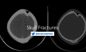 skull fractures header