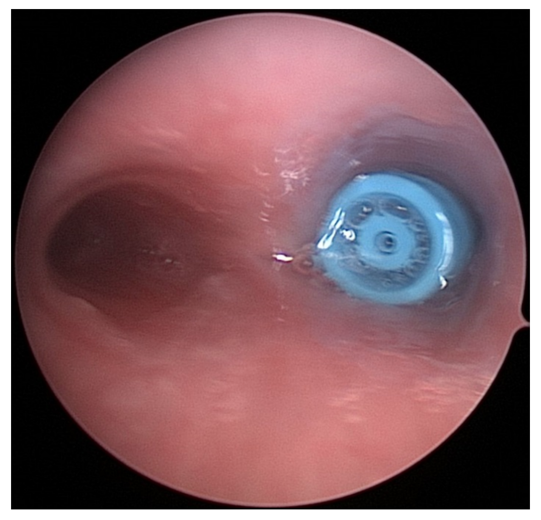 Foreign body in right Main stem bronchus on bronchoscopy