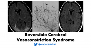 Reversible Cerebral Vasoconstriction Syndrome (RCVS) header