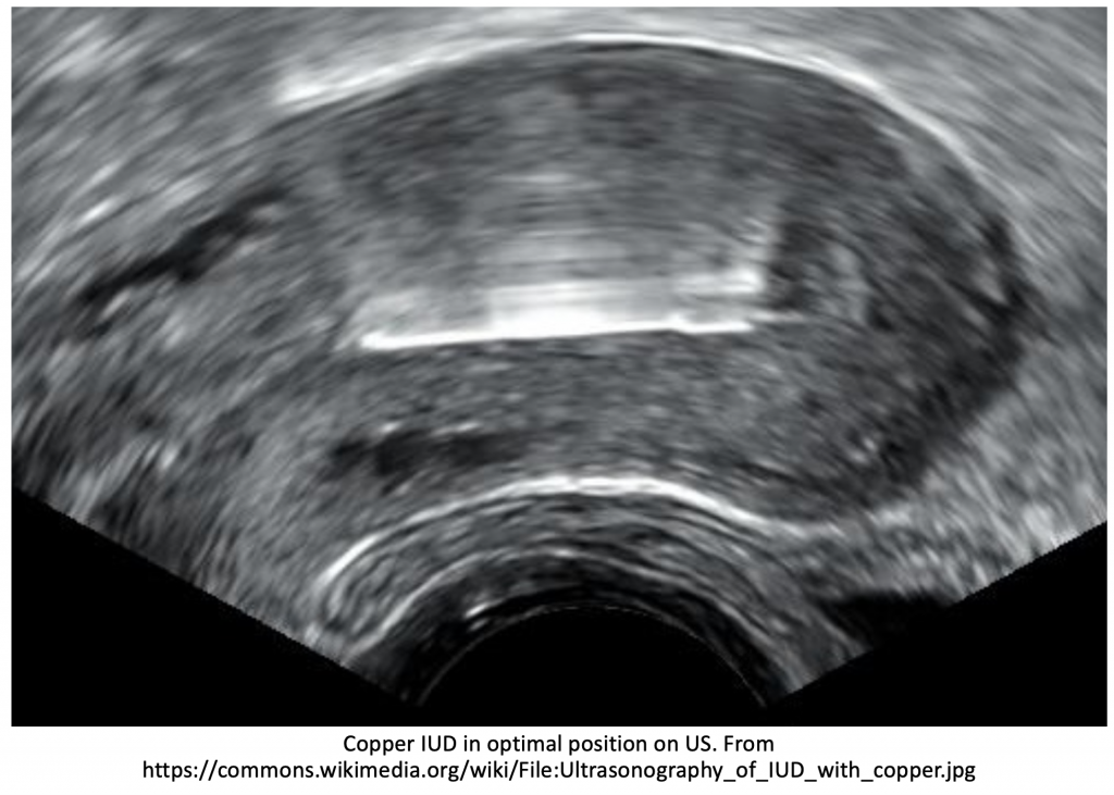 Migration Risk Iud emDOCs.net – Emergency Medicine EducationEM@3AM: IUD Complications ...