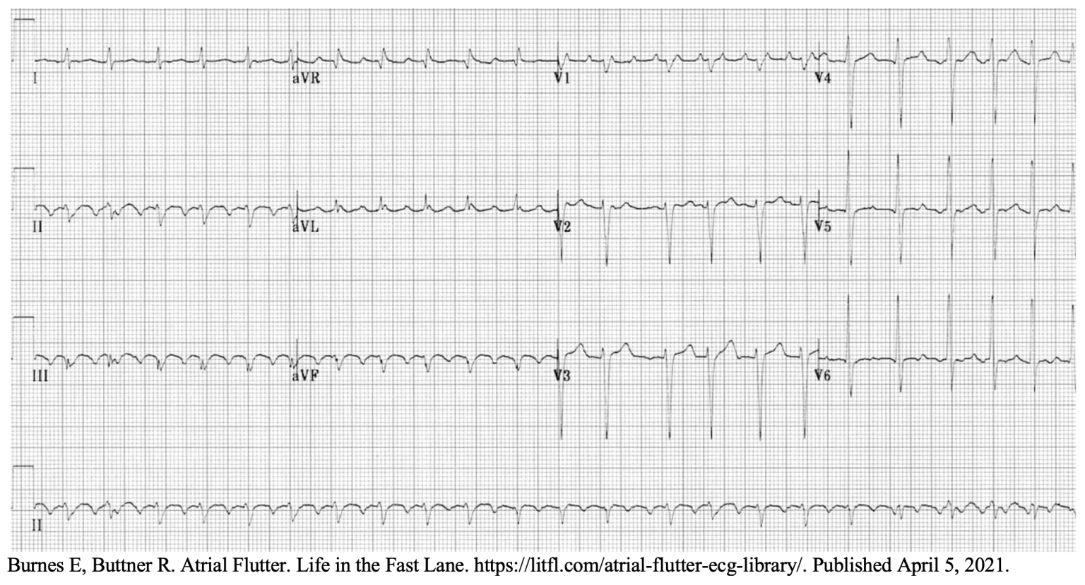 EM@3AM: Atrial Flutter - emDocs