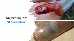 Nailbed injuries header